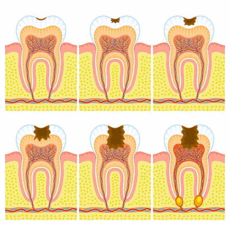 Deep cavity
